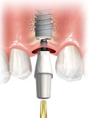 Figure 2 An abutment is placed into the implant.